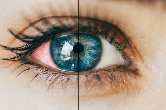 Glaucoma prevention tips